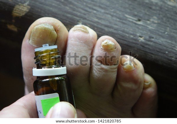 Toe Nail Fungus Doctor Treats Patients Stock Photo (Edit ...
