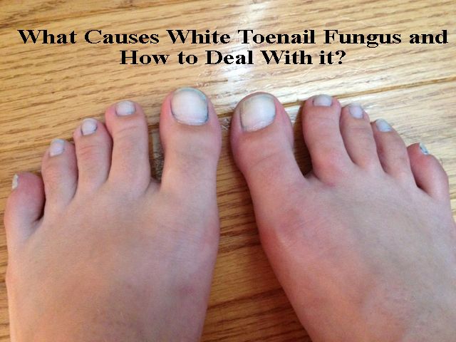 Toe Nail Polish for Fungus New White toenails Can Develop ...