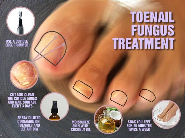 Toenail fungus, also known as foot fungus, has become a ...