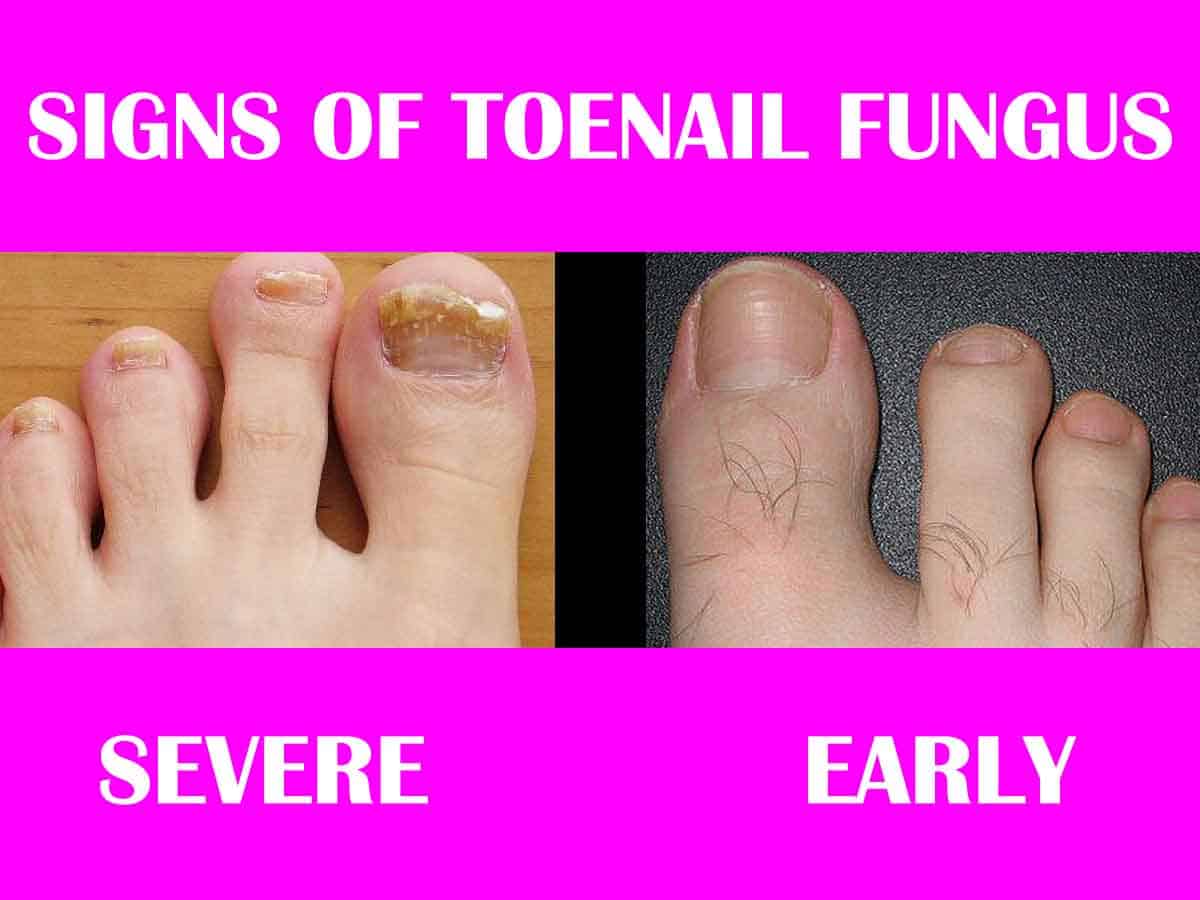 Toenail Fungus Blog ~ Warning Signs of Toenail Fungus