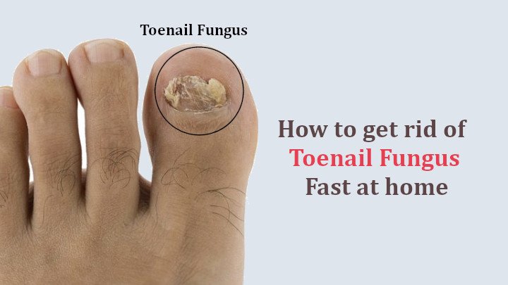 Toenail Fungus Cure: How to get rid of Toenail Fungus Fast ...
