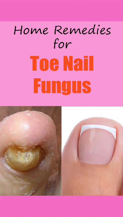 toenail fungus is treatable and actually quite easy to get ...