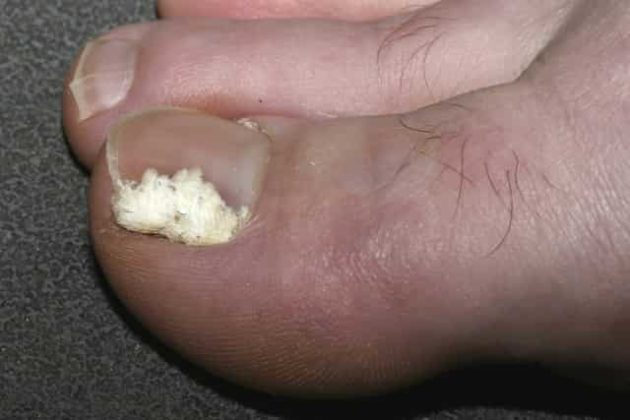 Toenail Fungus, Pictures, Causes, Symptoms, Get Rid, Cure ...