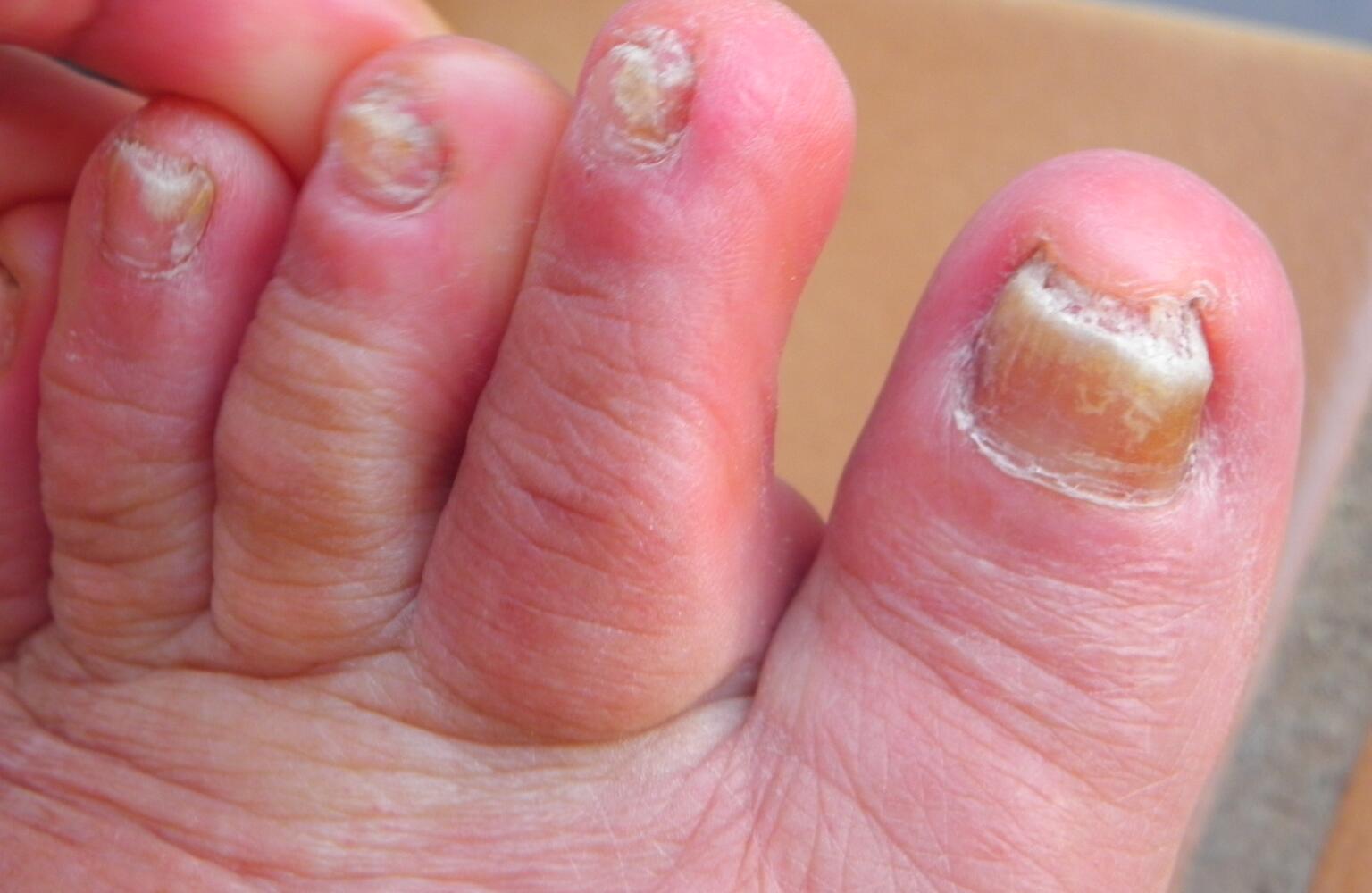 Toenail Fungus: Pictures, Treatment, Home Remedies &  Medication