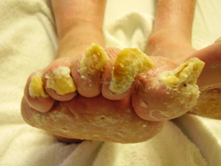 Toenail Fungus Remedy in 15 Minutes (for Bad Fungal ...