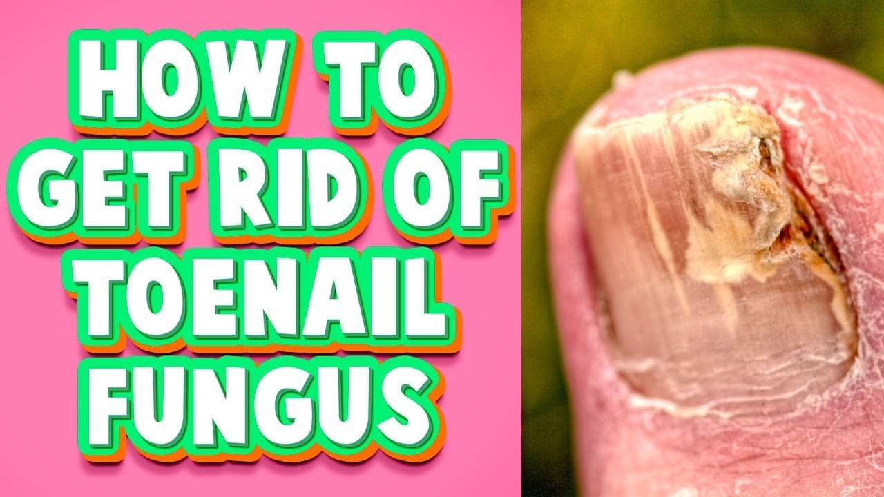 Toenail Fungus Treatment at Home: A Fast Cure You Must Try