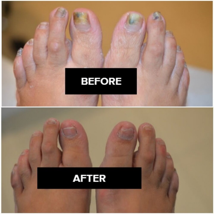 Toenail Fungus Treatment Before And After