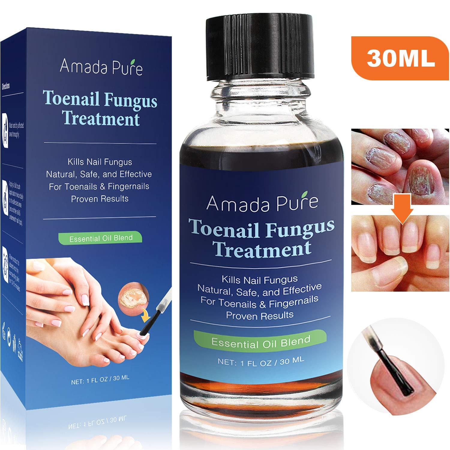 Toenail Fungus Treatment, Nail Fungus Treatment, Fungus ...