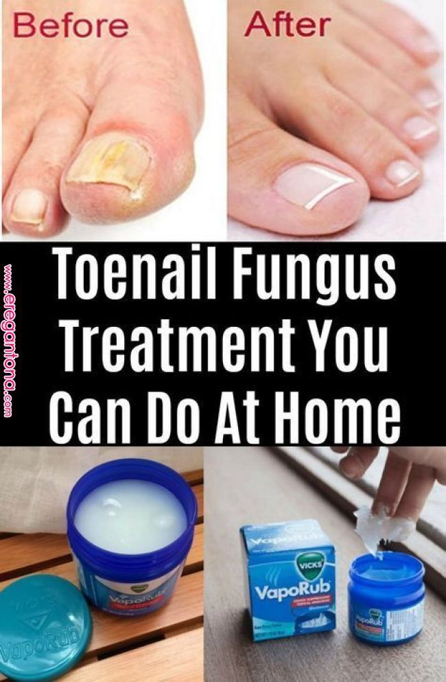 Toenail Fungus Treatment You Can Do At Home