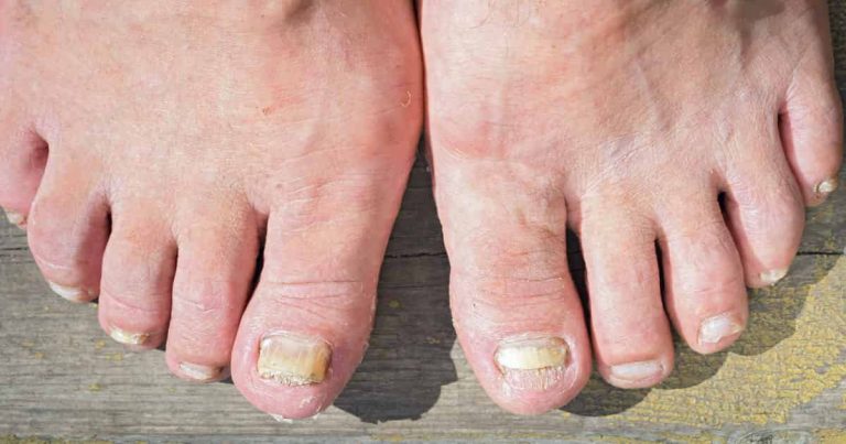 Toenail Fungus: Which Home Remedies Actually Work?