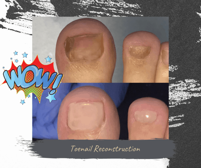 Toenail Reconstruction is the answer for damaged toenails