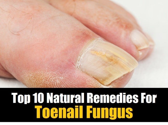 Top 10 Natural Remedies For Toenail Fungus