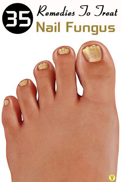 Top 37 Home Remedies To Treat Nail Fungus