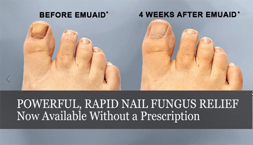 Top 5 Best Nail Fungus Treatment Products Reviewed
