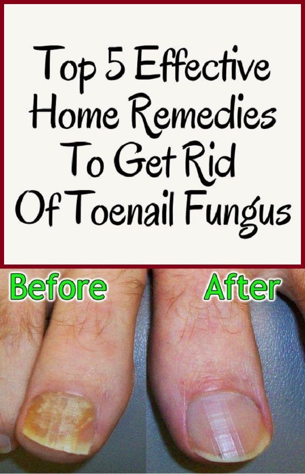 Top 5 Effective Home Remedies To Get Rid Of Toenail Fungus ...