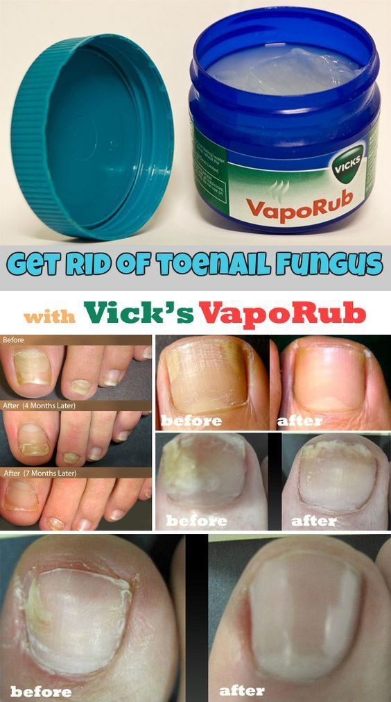 treat toenail and finger fungus