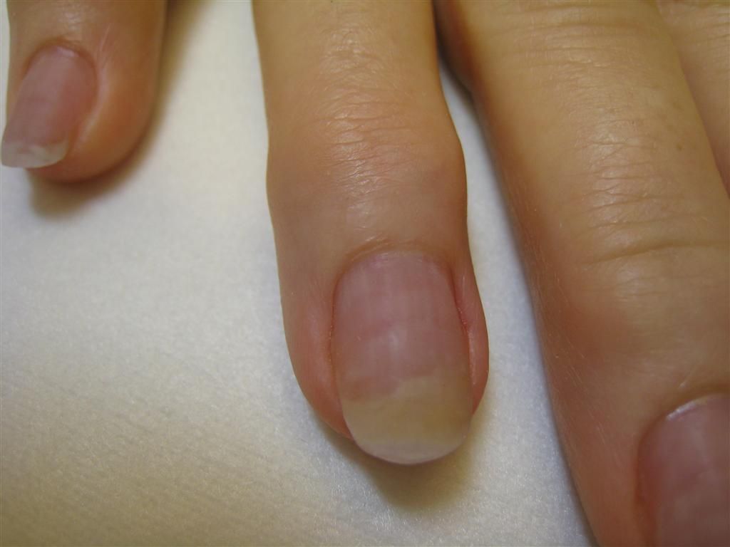 Tried And True Home Remedies For Nail Fungus