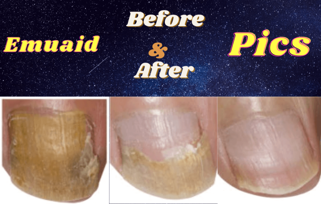 Ultimate Guide To Use Emuaid For Nail Fungus Effectively