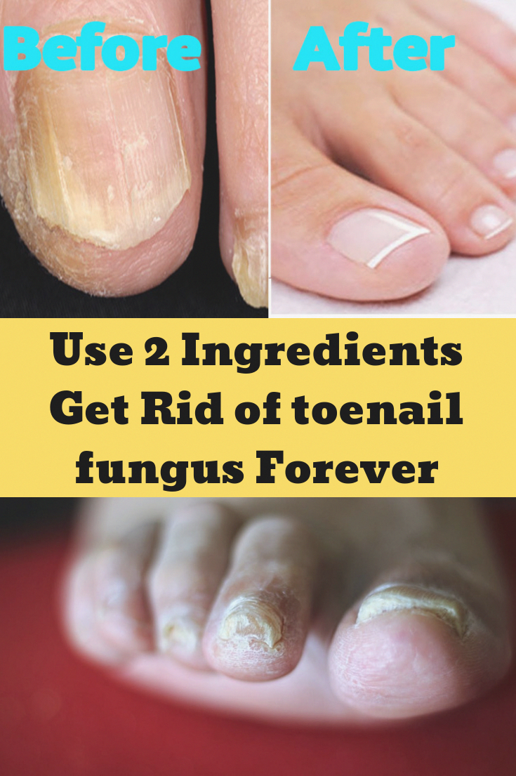 Use 2 Ingredients Get Rid of toenail fungus Forever # ...