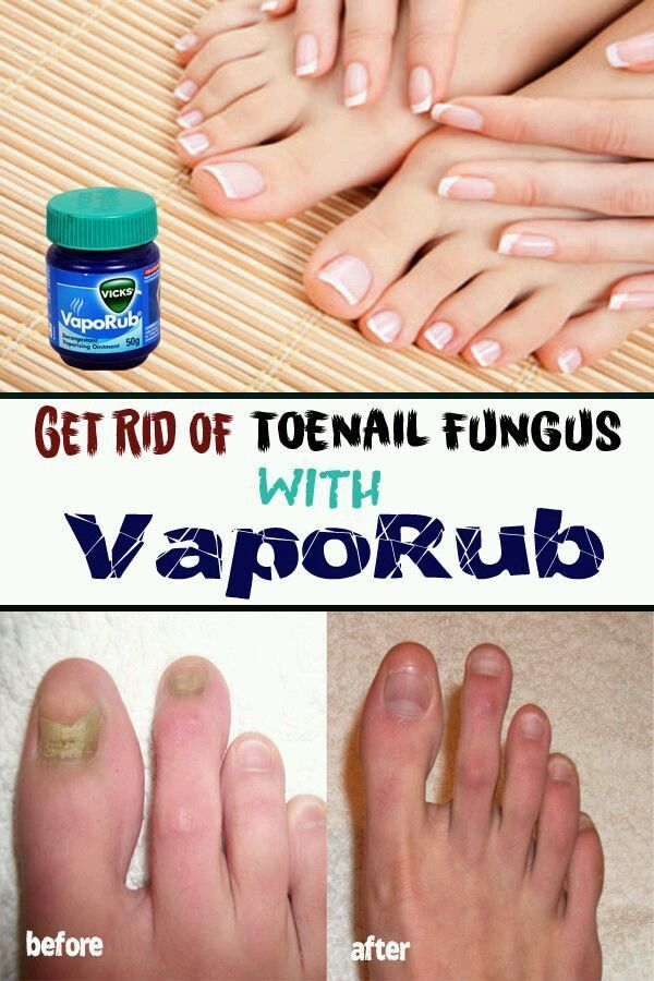ÙØµÙ?Ø© Ù?Ø¹Ø§ÙØ© Ù?Ù Ø¹ÙØ§Ø¬ ØªØ¹Ù?Ù Ø§ÙØ§Ø¸Ø§Ù?Ø± ÙØªØ±Ø·ÙØ¨ Ø§ÙÙØ¯Ù Get rid of toenail fungus ...