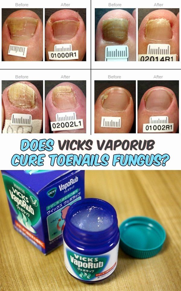 Vicks Nail Fungus Cure Unique Does Vicks Vaporub Cure ...