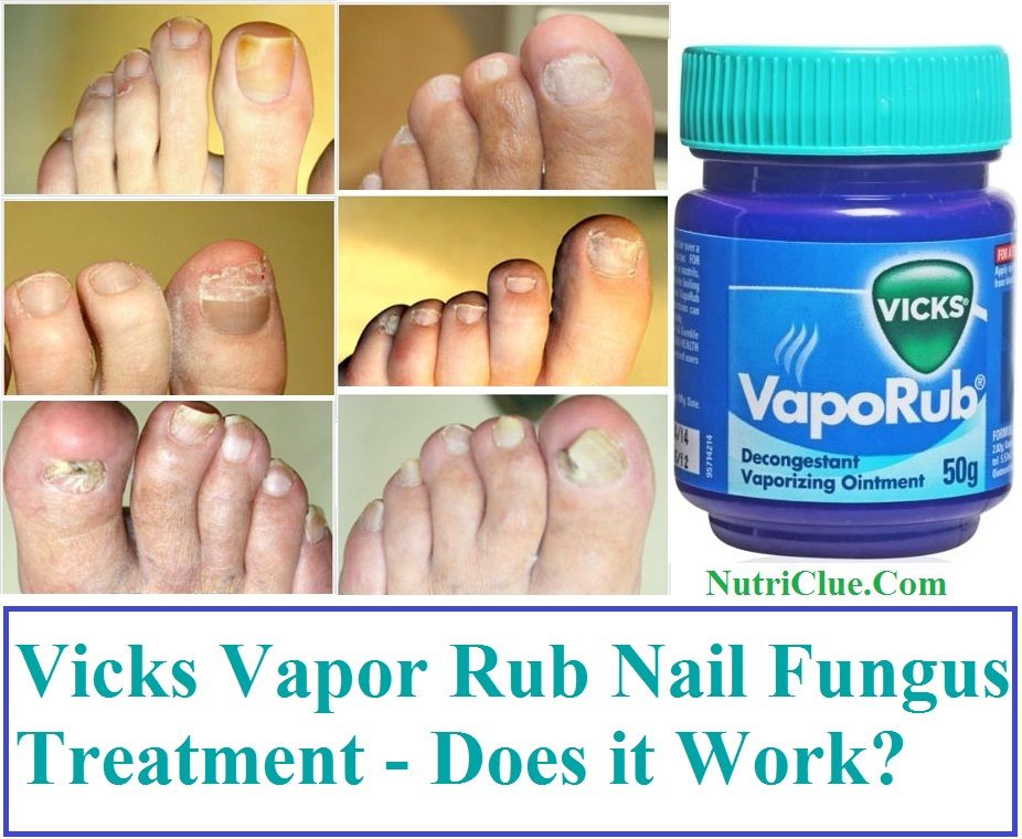 Vicks vapor rub, Nail fungus, Vicks vapor