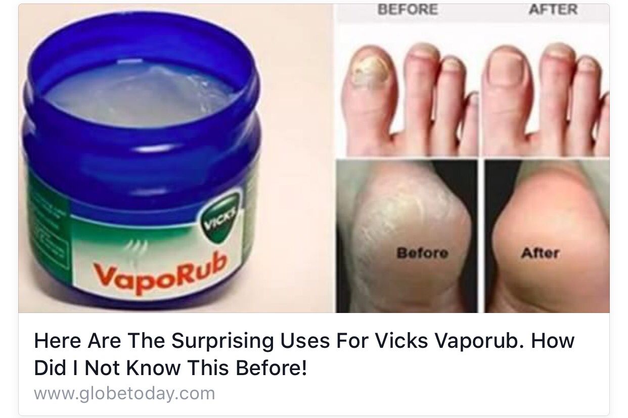 Vicks Vapor Rub Uses Nail Fungus