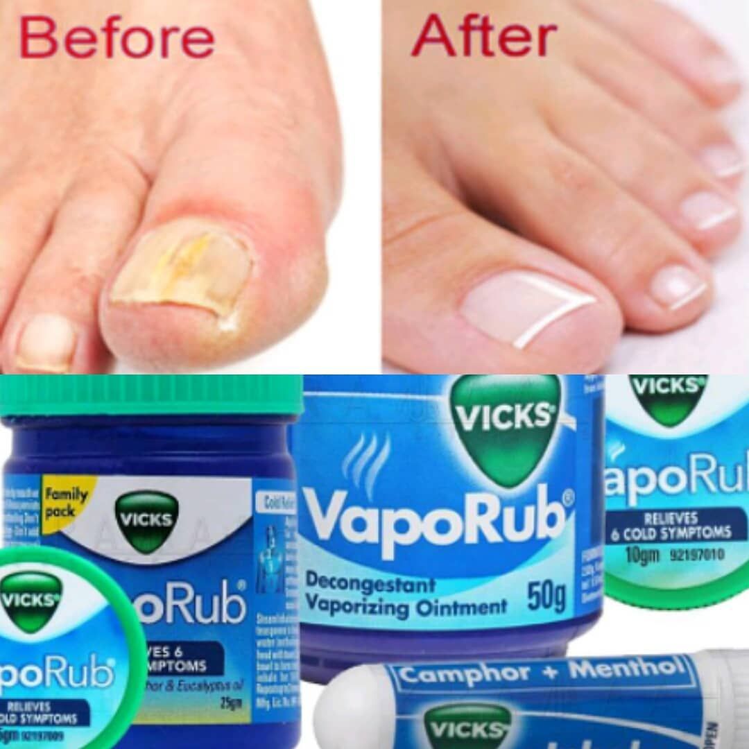 Vicks vaporub can clear up toenail fungus AND brittle discolored ...