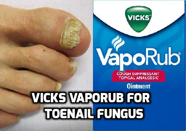 Vicks VapoRub for Toenail Fungus