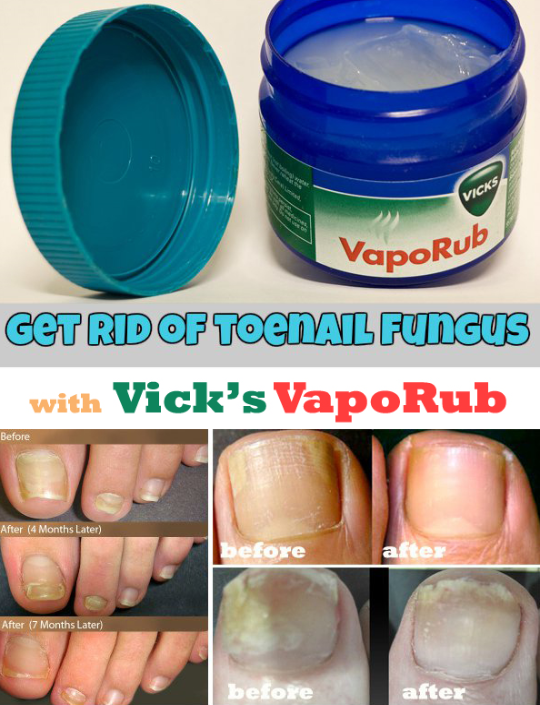 Vicks vaporub for toenail fungus treatment, MISHKANET.COM