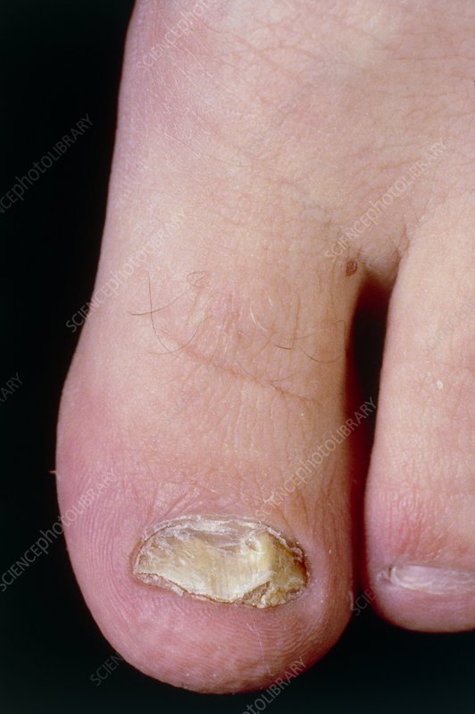 View of a fungal infection in toenail of big toe