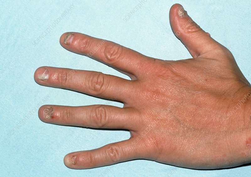 View of hand with fungal nail infection (tinea)