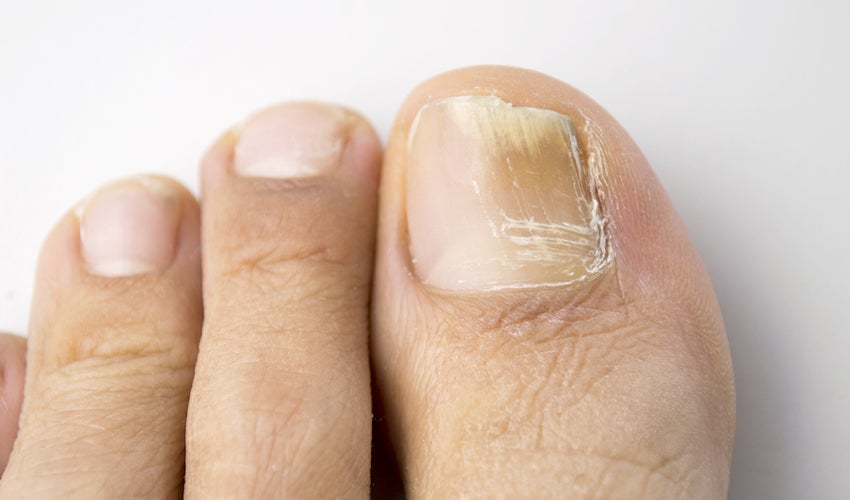 What Causes Foot &  Toenail Fungus?