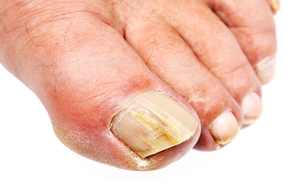 What Causes Toenail Fungus? How to Prevent Onychomycosis ...