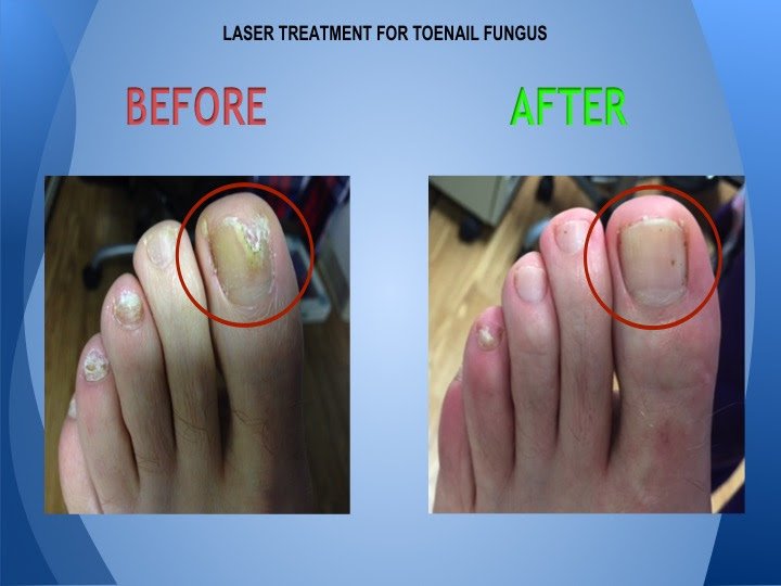 What Doctor To See For Toenail Fungus