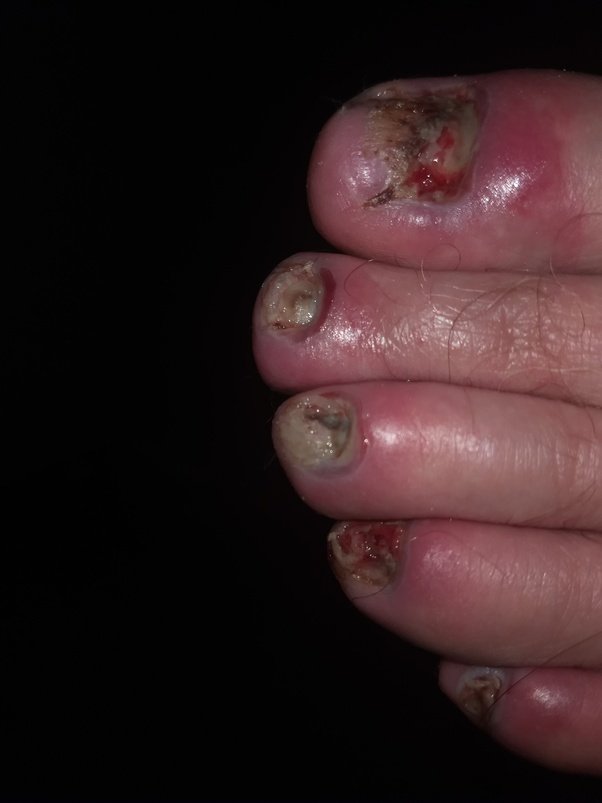 What is an the cheapest way to get rid of toenail fungus ...
