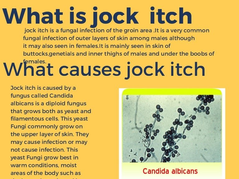 What is jock itch