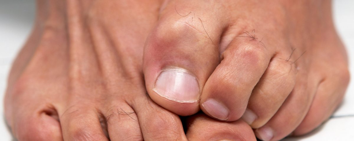 What Is The Fastest Way To Get Rid Of Nail Fungus ...