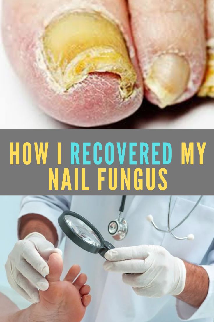 What is The Very Best Toe Nail Fungus Home Remedies &  How Do I Treat ...