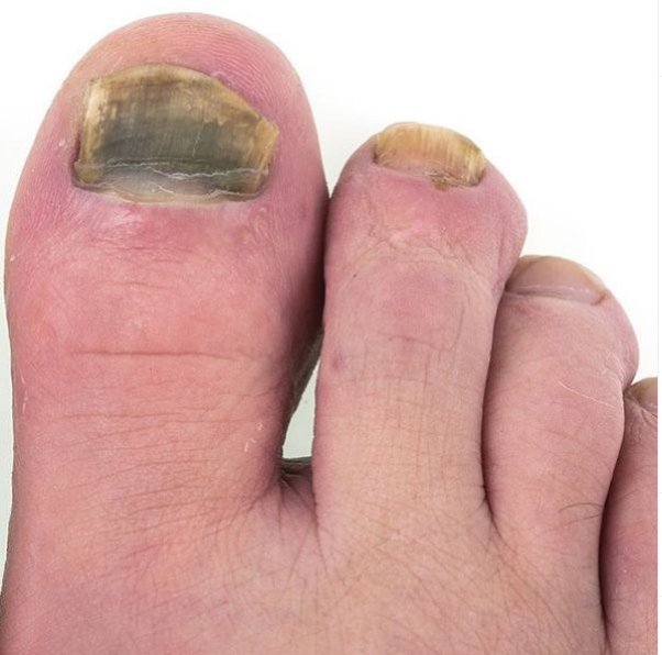What is toenail fungus?