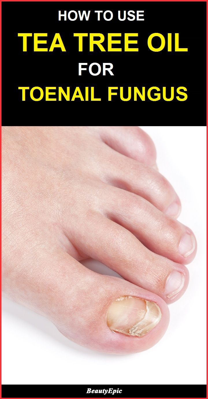 What Kind Of Doctor For Toenail Fungus