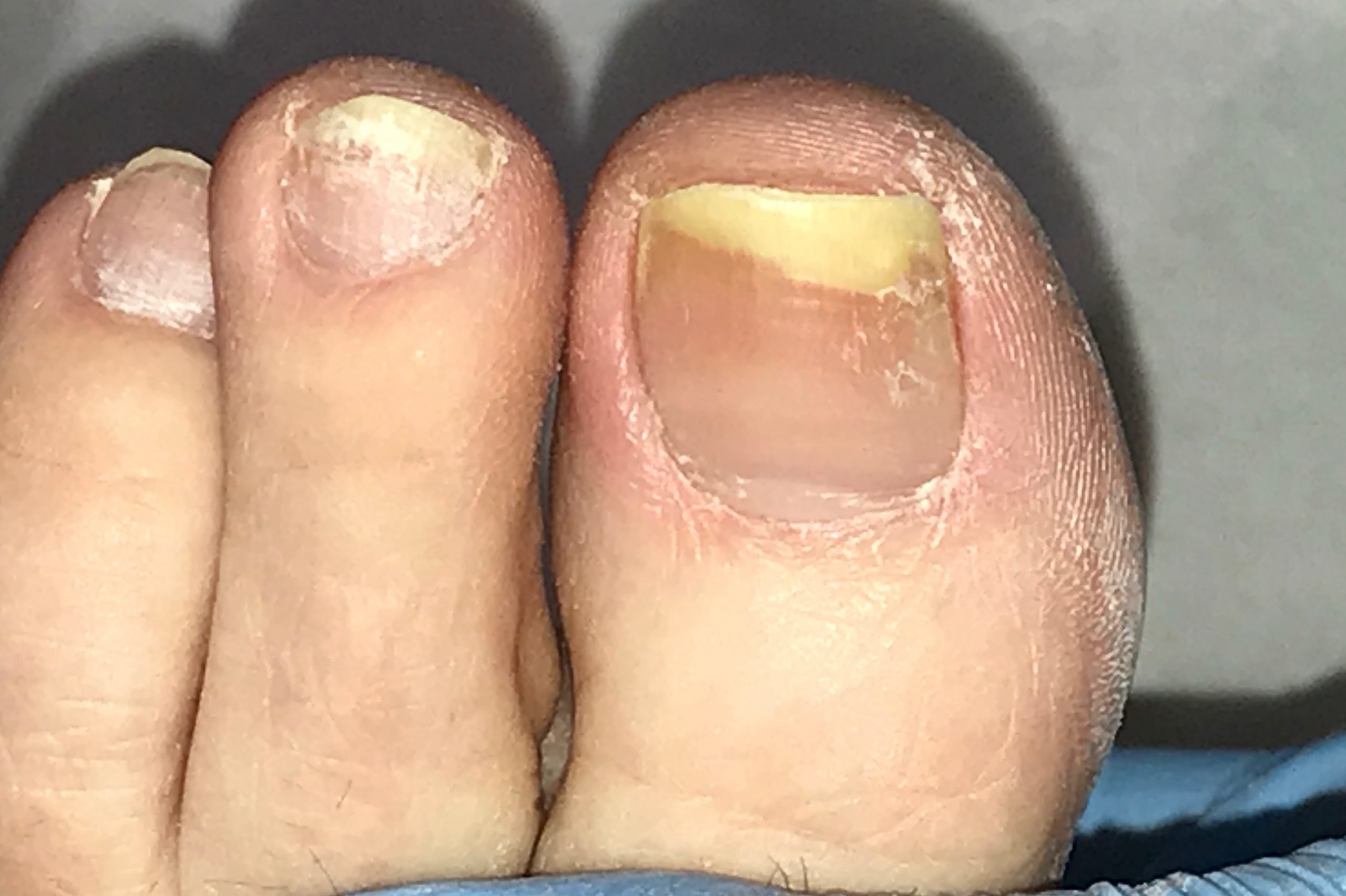 What Should I do If My Nails Are Fungal?  Care For Feet