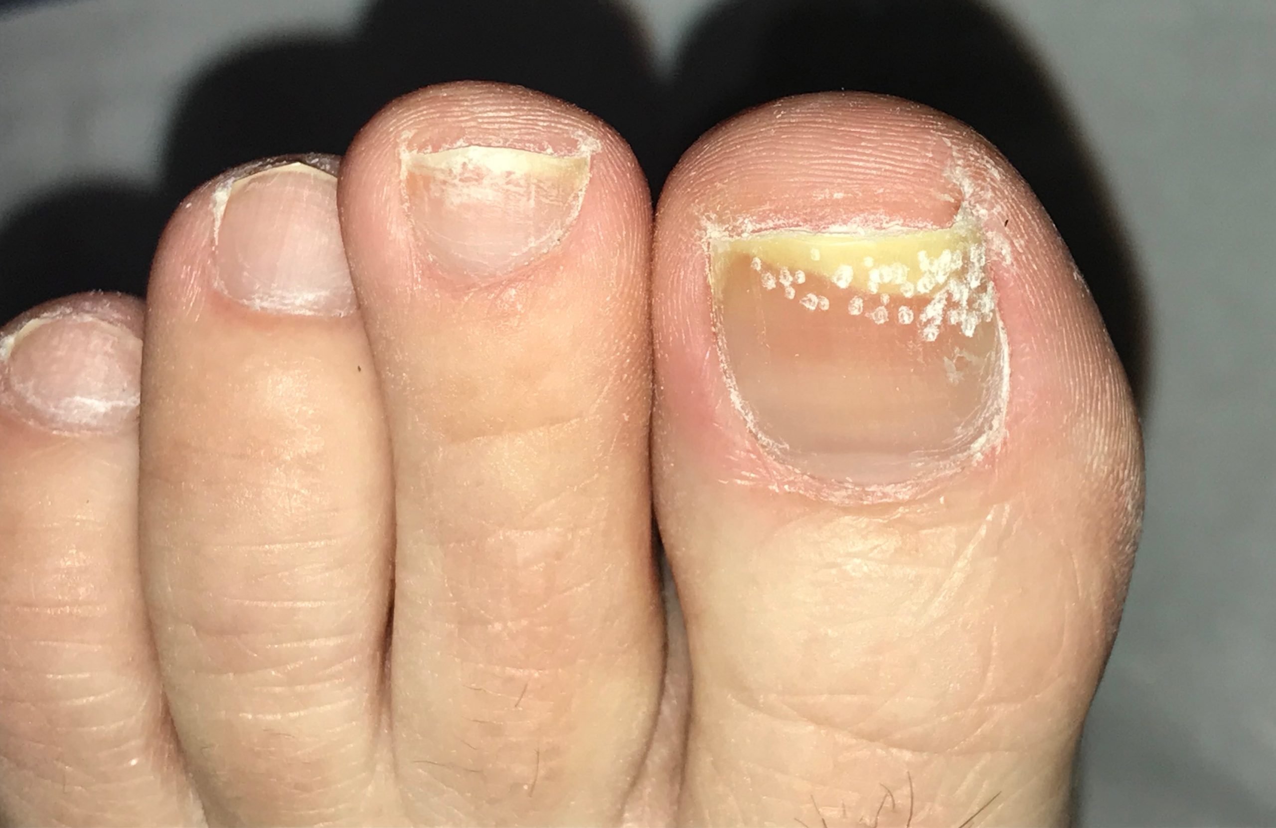 What Should I do If My Toenails Are Fungal?  Care For Feet