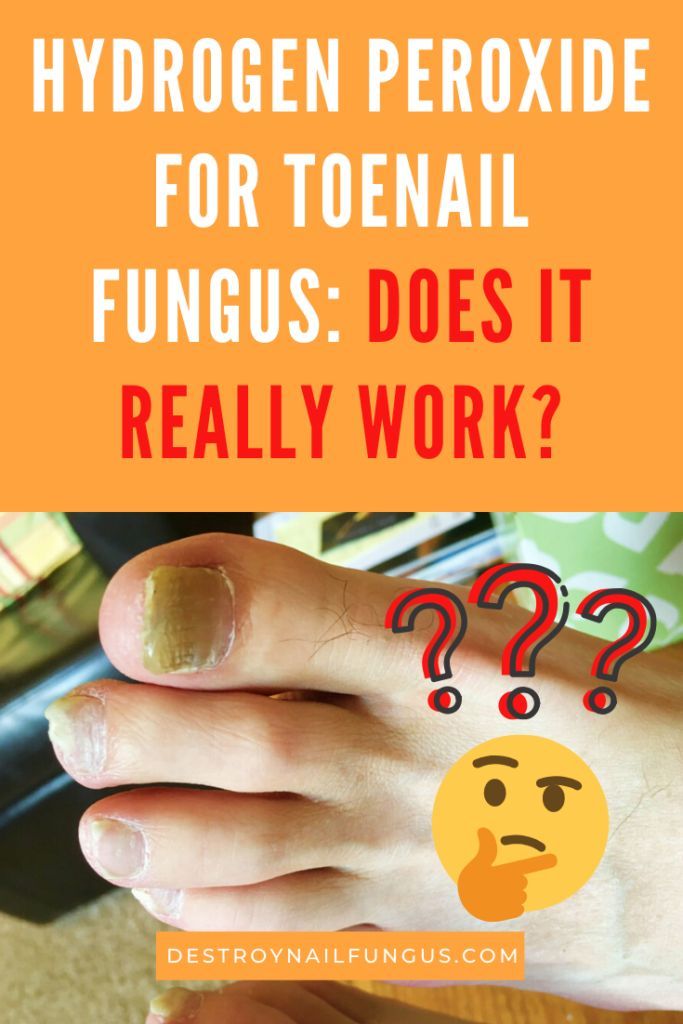 What You Need to Know about Hydrogen Peroxide and Toenail Fungus ...