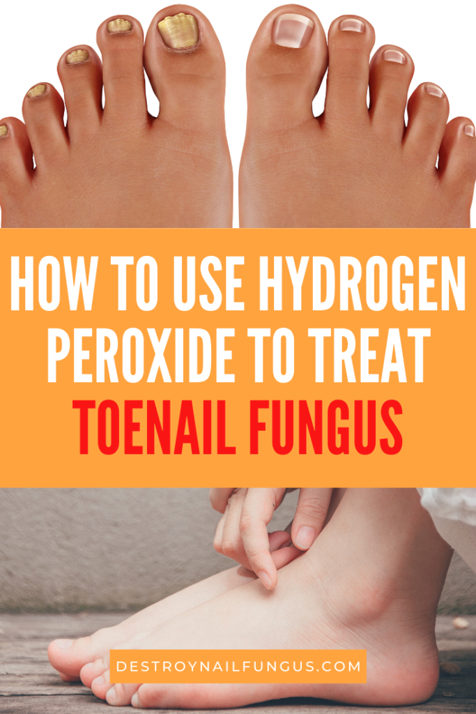 What You Need to Know about Hydrogen Peroxide and Toenail ...