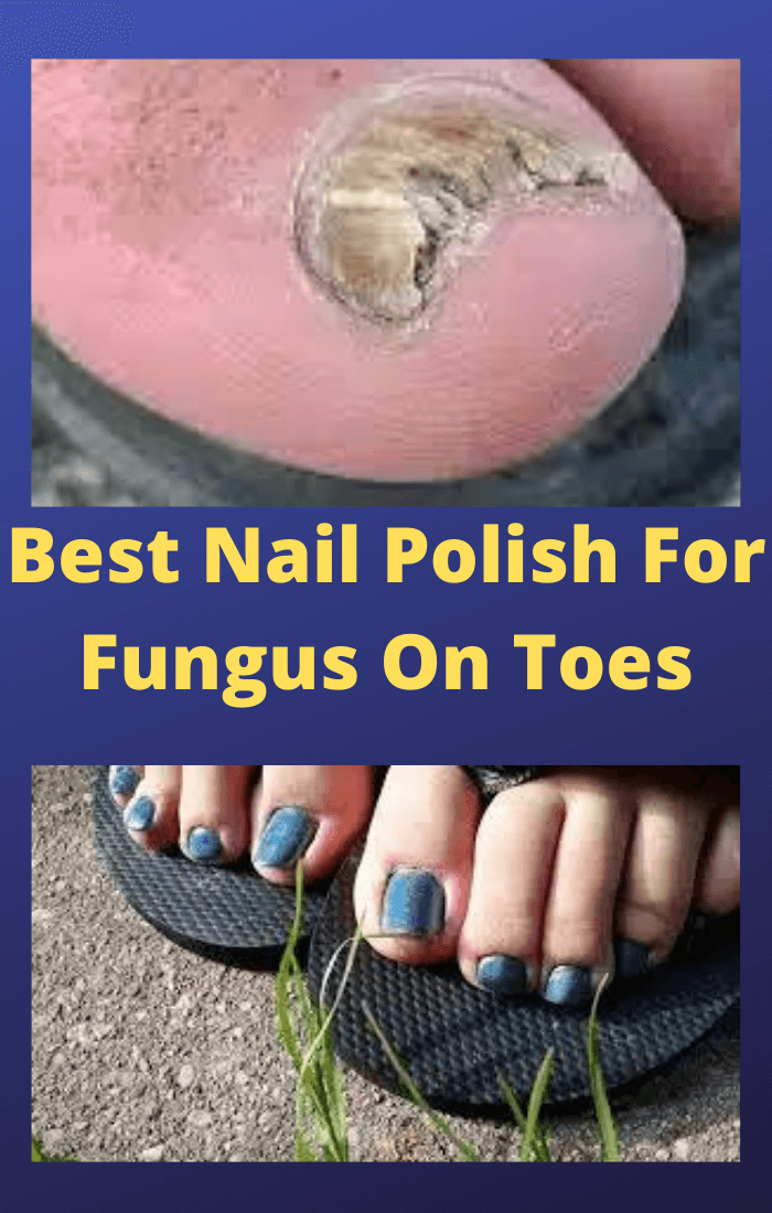 Whats The Best Nail Polish For Fungus On Toes