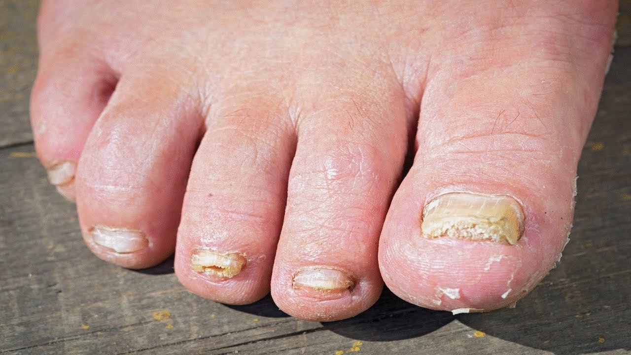 Which Toenail Fungus Treatments That Really Work?