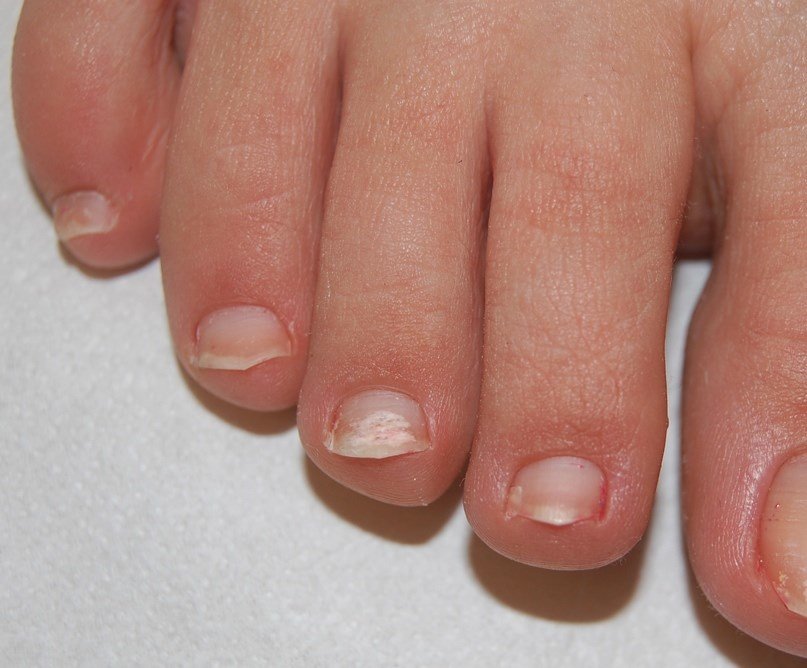White Discoloration On Toenails After Nail Polish