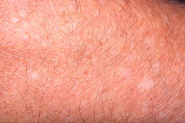 White Spots on Skin, Patches, Pictures, Small, Sun, Fungus ...