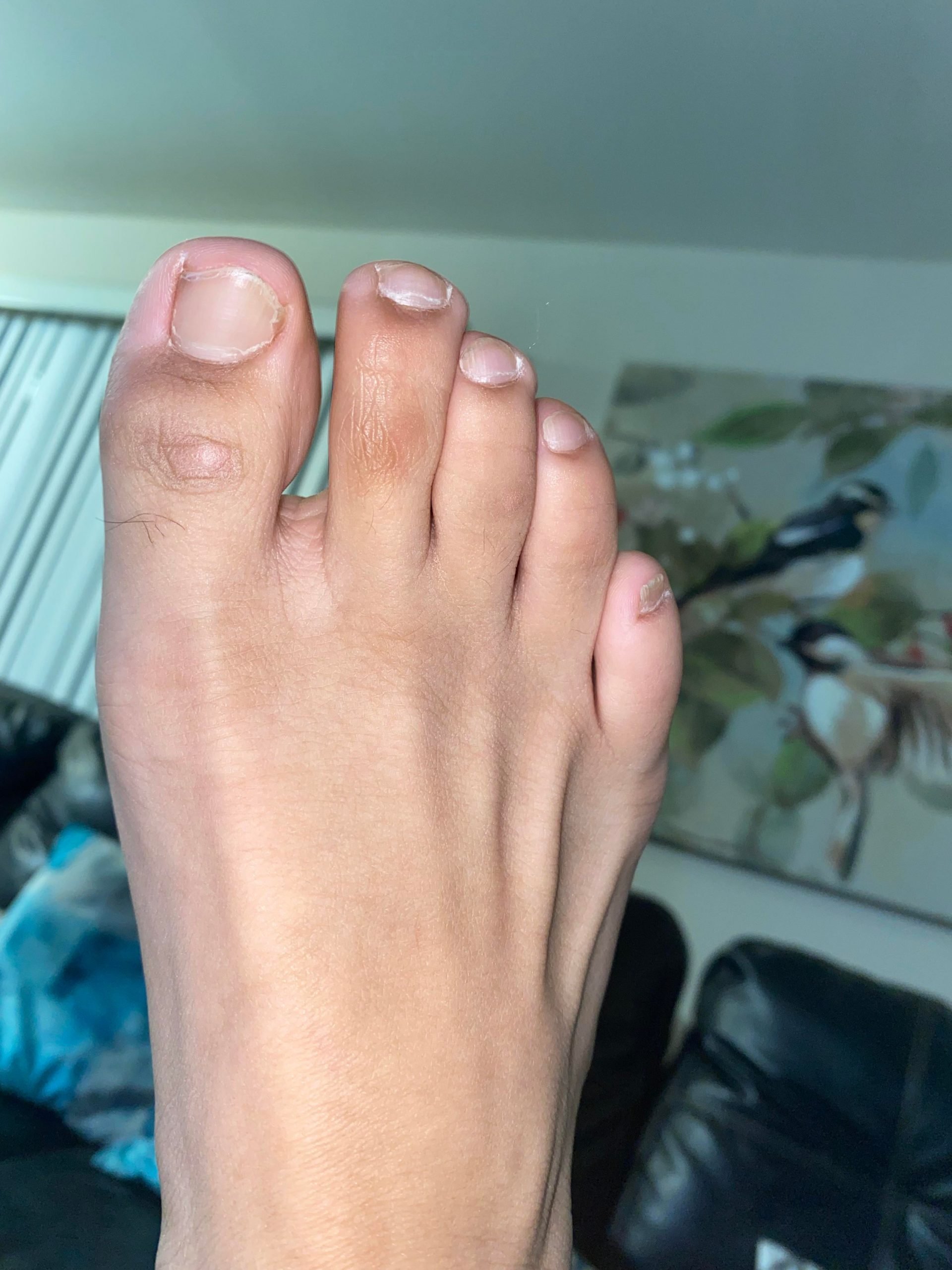 Why does my big toe look discolored. Is this fungus? I have it on both ...